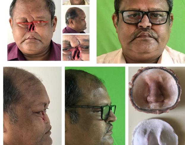 Patient side view with prosthesis