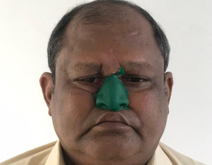 Patient with facial prosthesis front view