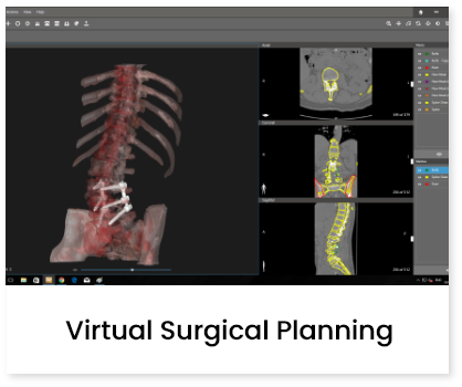 Virtual Surgical planning