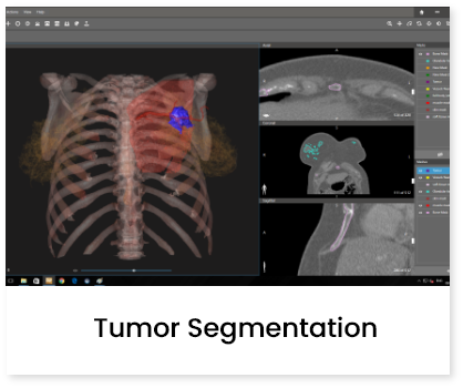 Tumor Segmentation