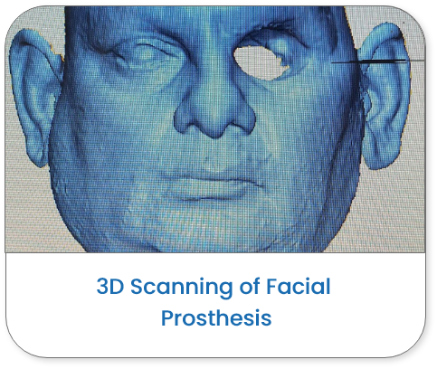 3D scanning facial prosthesis