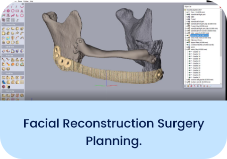 Facial reconstruction surgery planning