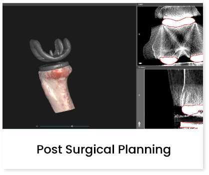 Post Surgical Planning