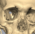 Maxillofacial