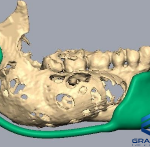 Surgical cutting Guide in Freeform software