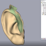 Ear Prosthesis