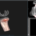 Patient Surgical Planning