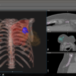 Identifying Tumor in D2P