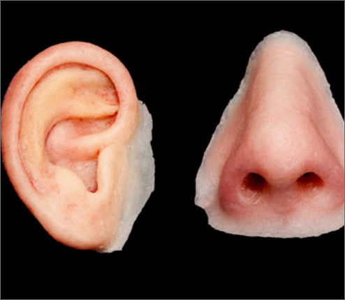 Artificial Nose & ear prosthesis