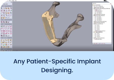 Patient Specific Implant