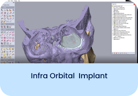 Infra orbital implant